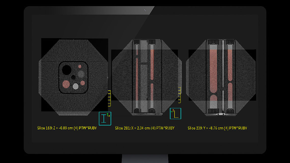 SYSTEM QA Fusion of RUBY CT and MRI images as shown in the treatment planning system (grey: CT / red: MRI)