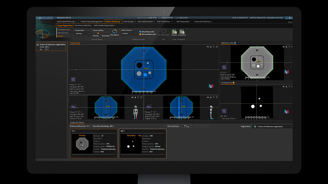 SYSTEM QA Fusion of RUBY CT and MRI images in RayStation treatment planning system